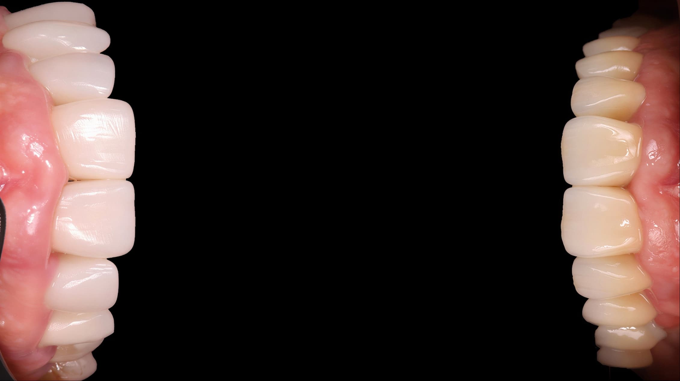 Branqueamento Dentário